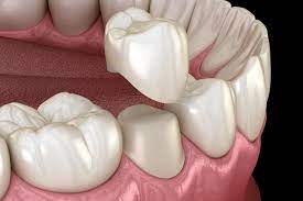 Ceramic Crowns