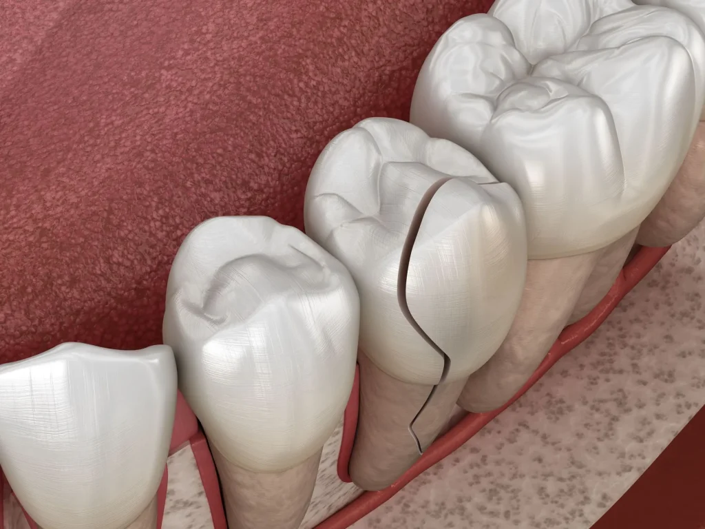 cracked-tooth