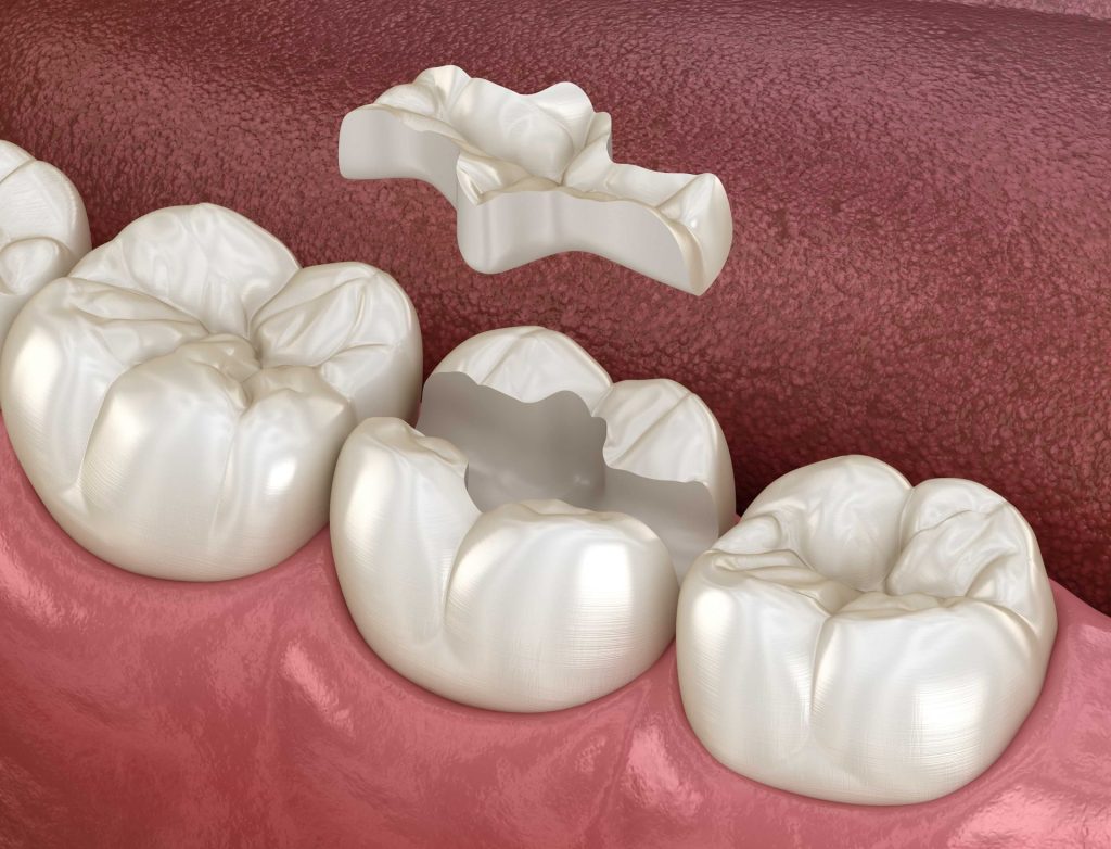 dental-crown